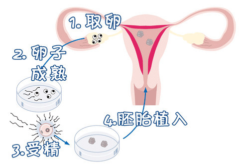 正规有偿捐卵